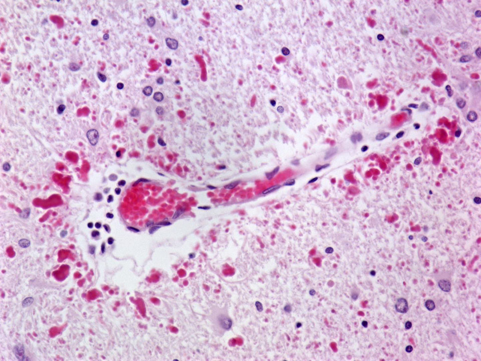 Alexander Disease