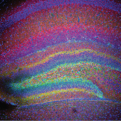 hypoxia-ischemia in the brain
