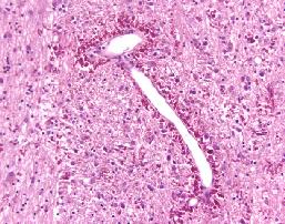 Alexander disease