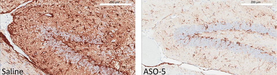 Alexander disease treatment