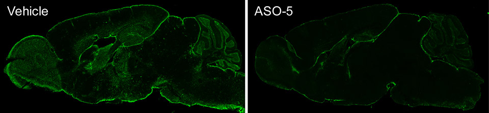 Alexander disease treatment