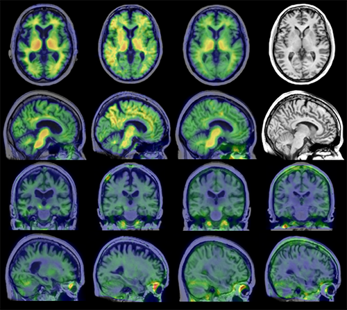 PET Scan