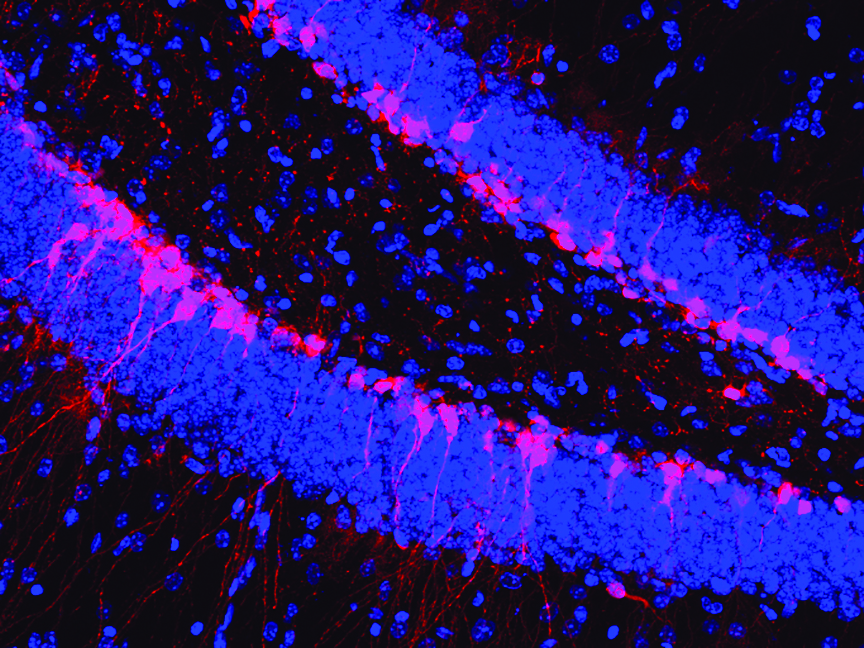 Cancer drug may be treatment option for fragile X syndrome