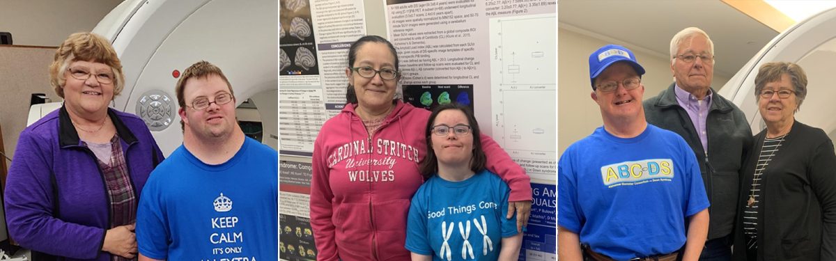 Weight loss may be early predictor of Alzheimer’s disease in Down syndrome