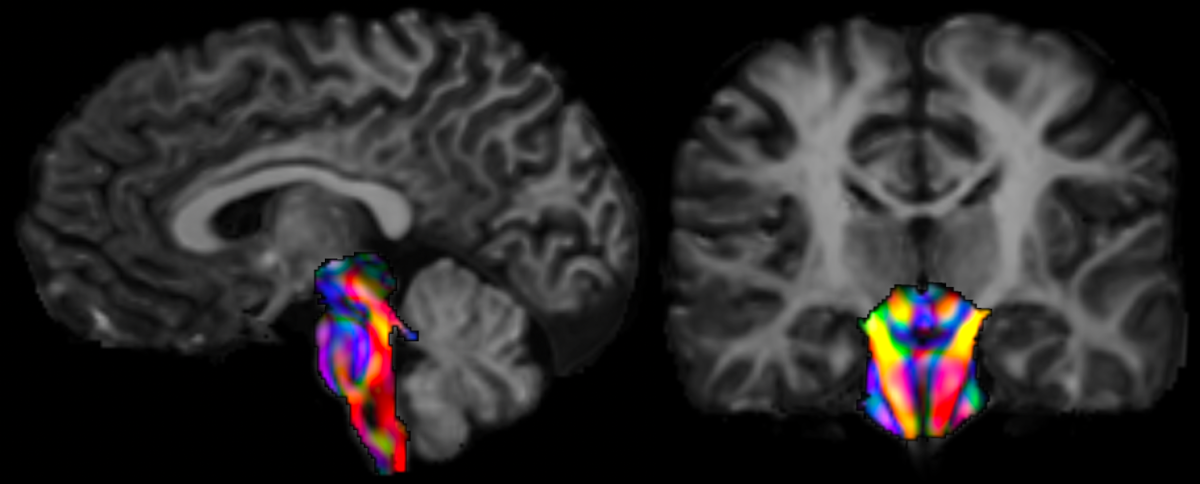 Sensory responses in autistic children are linked to a small under-explored region tucked deep down in the brain called the brainstem