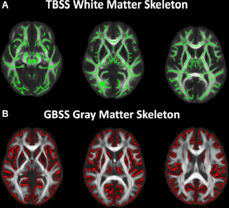 Study reveals differences in brain structure for older autistic adults