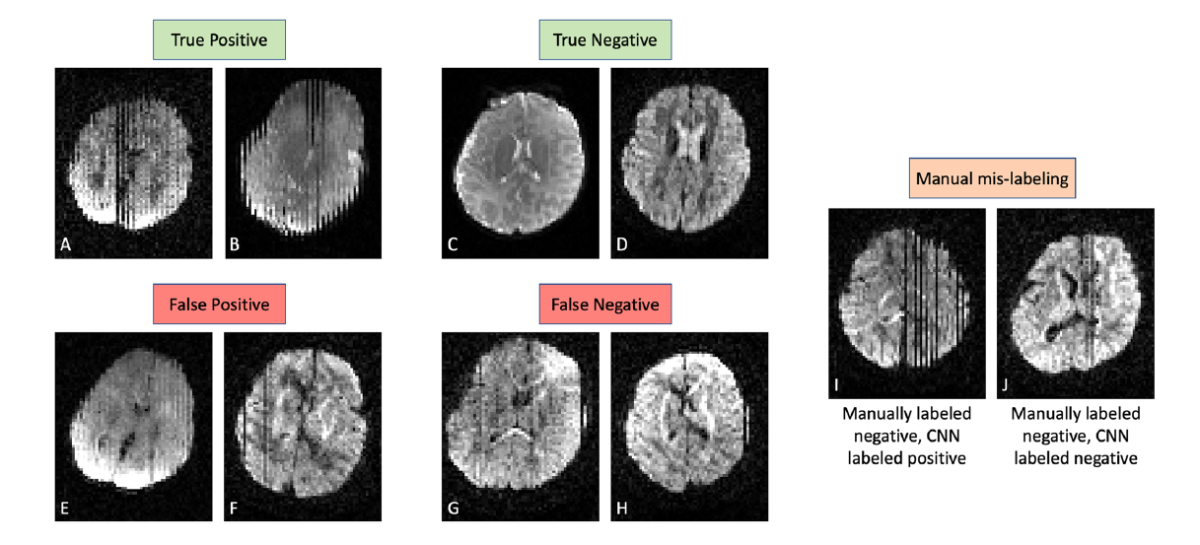 Developing a neural network to overcome the biggest enemy of MRI scans: movement