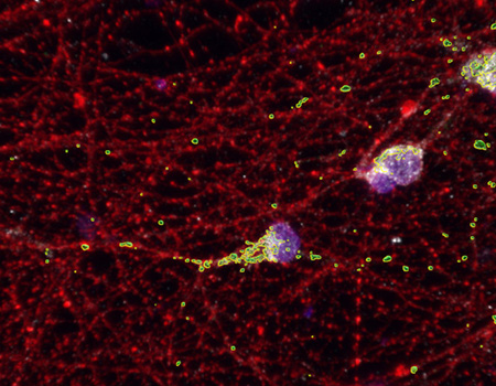 Fragile X Neurons