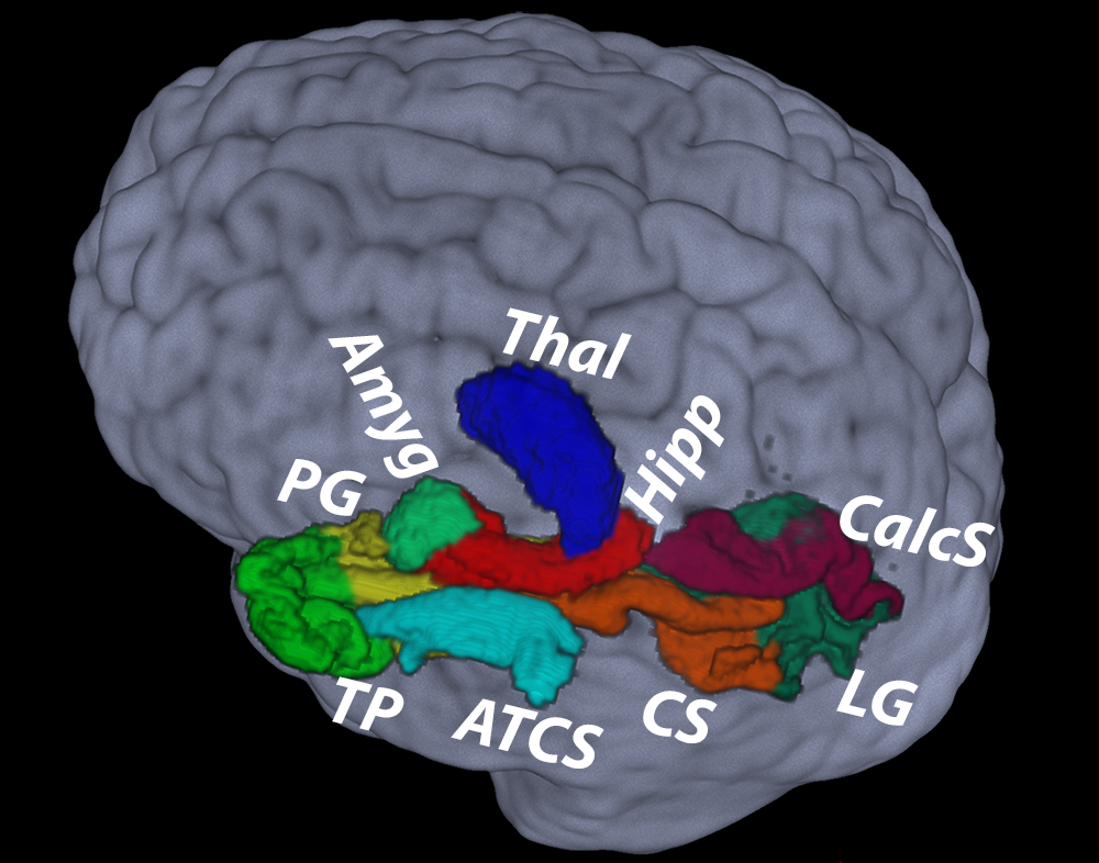 Memory impairment after severe traumatic brain injury in adolescents related to size and connectivity changes in the hippocampus and beyond.