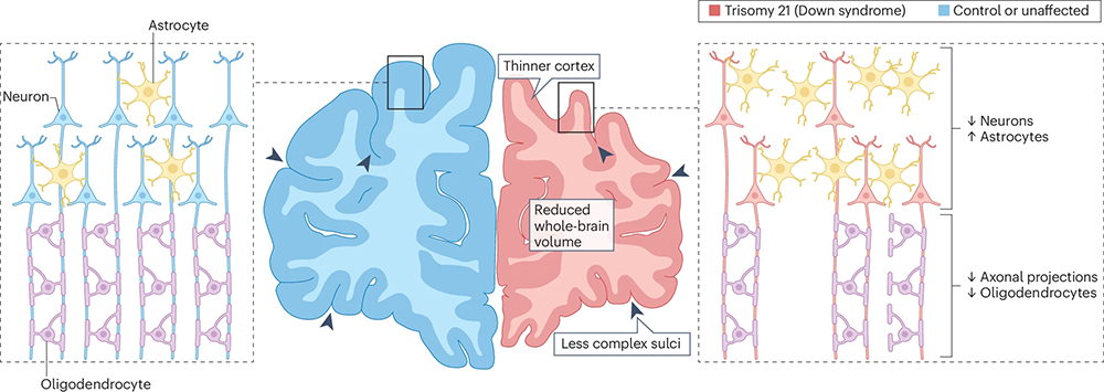 What research has revealed about Down syndrome’s influence on brain development