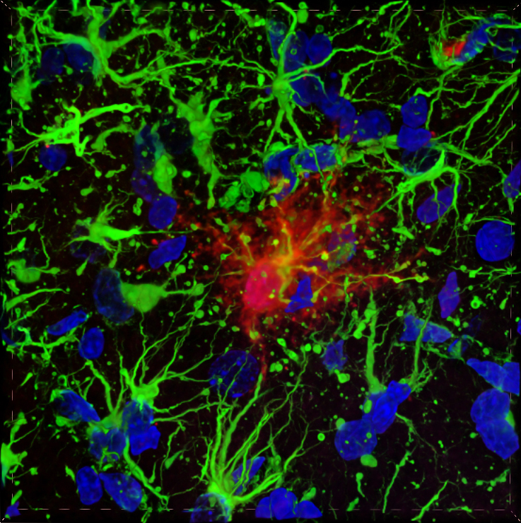 New research reveals parallels between Alexander disease and other neurodegenerative conditions like Alzheimer’s disease