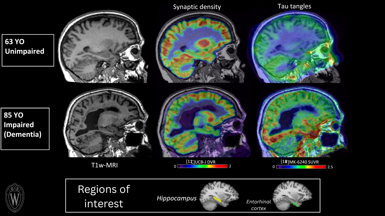 MRI and PET images of synaptic density and neurofibrillary tau tangles