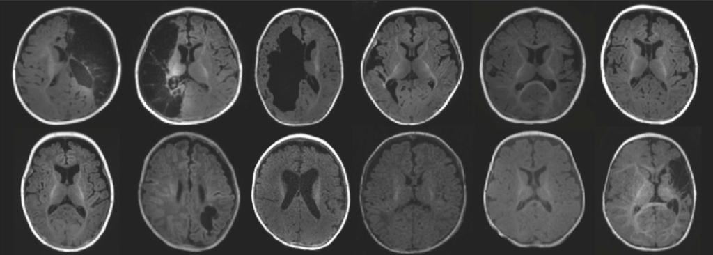 Atypical infant movements tied to cerebral palsy may signal differences in brain connectivity