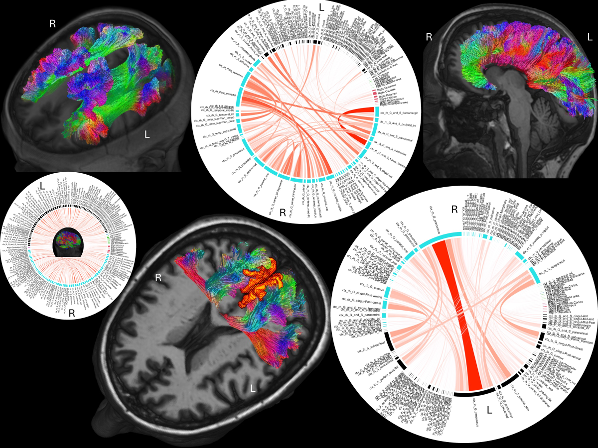 How advanced MRI paired with neuropsychological testing shed light on how Temple Grandin’s brain processes the world