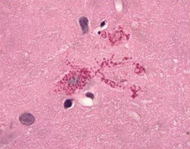 Astrocytes, Rosenthal fibers – Alexander Disease