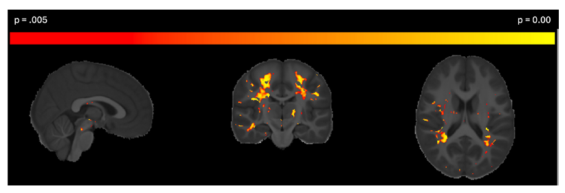 MRI heatmaps of MRI images with yellow and red marks of areas of negative association between ADI and myelin.
